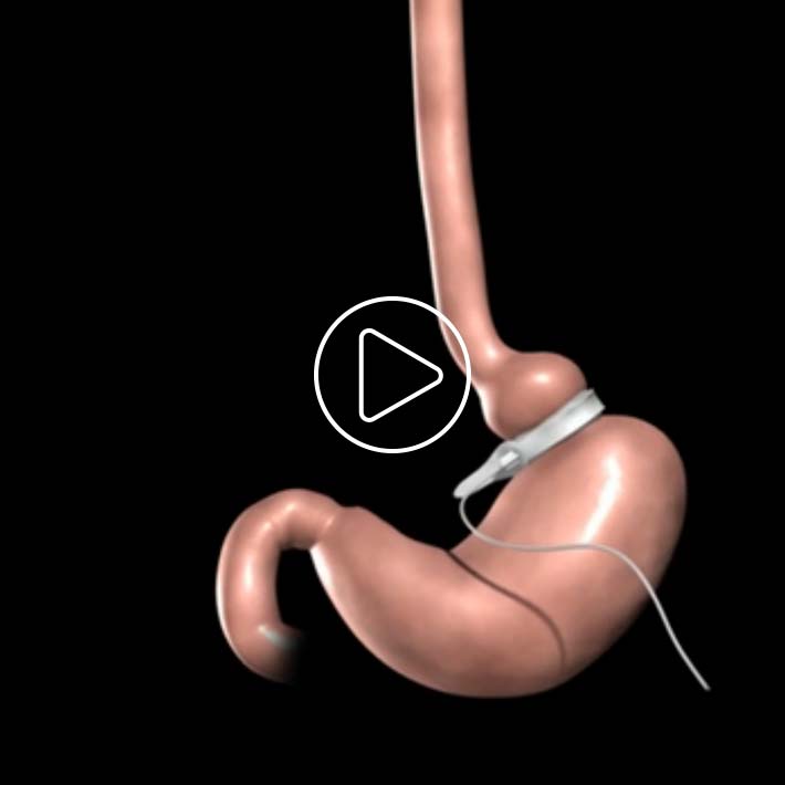 Adjustable Gastric Banding 